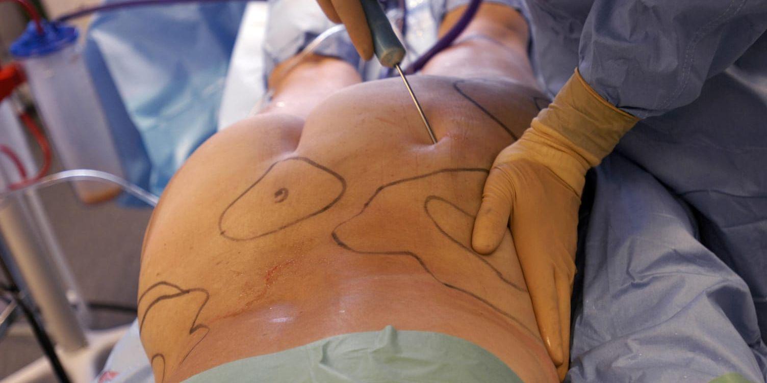Plastikkirurgen Ulf Samuelson möter regelbundet patienter som har problem efter både estetiska injektioner och plastikkirurgi. På bilden en fettsugning av mage och lår på Akademikliniken på Östermalm.