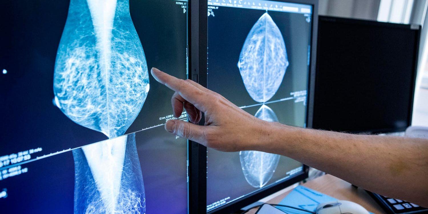 Ett implantat skymmer bröstvävnaden till 80 procent, säger Karin Leifland som är verksamhetsområdeschef för bilddiagnostik och onkologi vid Södersjukhuset i Stockholm.